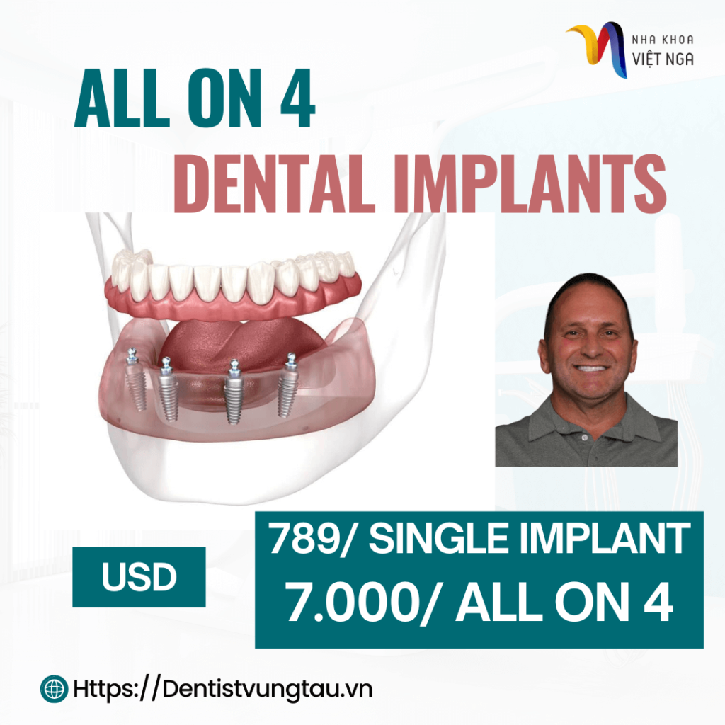 All on 4 dental implants cost in Vung Tau